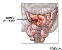 Bowel Obstruction Settlement