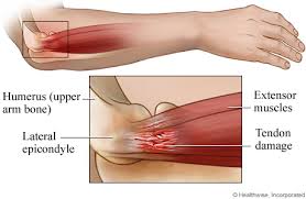 Elbow Injury