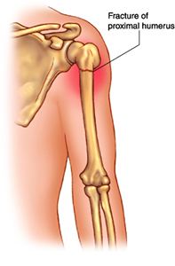 fracture humeral head