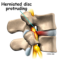 Lumbar Surgeries